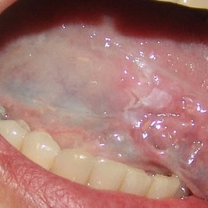 Лечение заболеваний слизистой оболочки рта