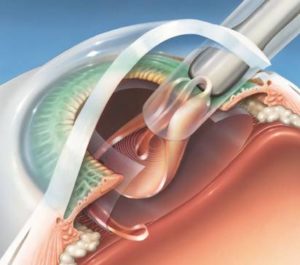 Рефракционная замена хрусталика